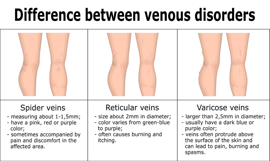 Sonoma Vein Cardiovascular Laser Group Difference Between Venous Disorders